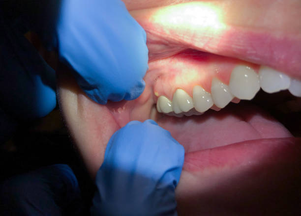 Best Emergency Broken Tooth Repair in Cedar Springs, MI